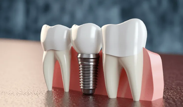 10 Places That Offer Free Dental Implants