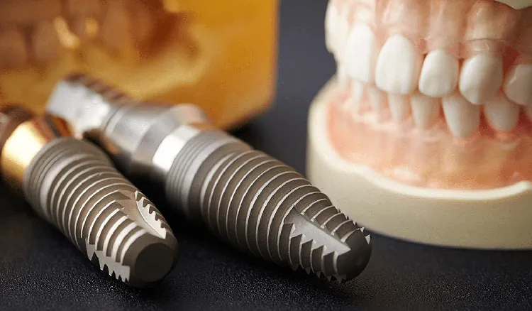 Affordable Dental Implants: Cost and Options