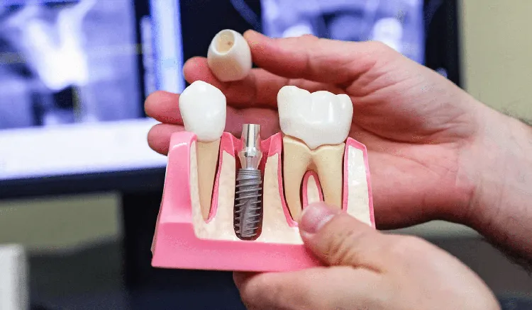Affordable Dental Implants for Low-Income Patients