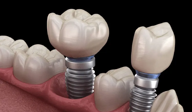 Affordable Dental Implants Near Me [2023]