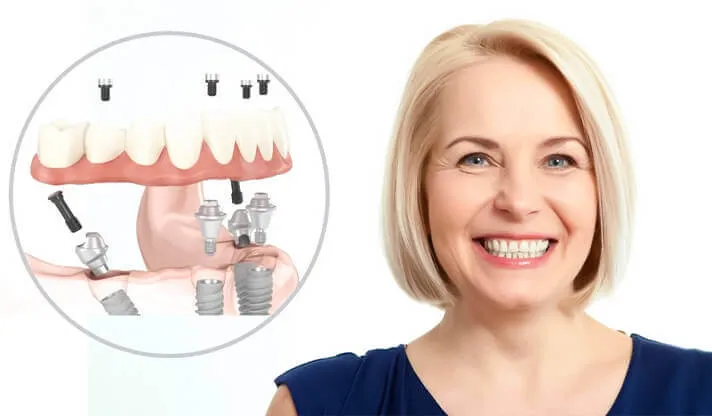 Dental Implants for Seniors: Everything You Need to Know