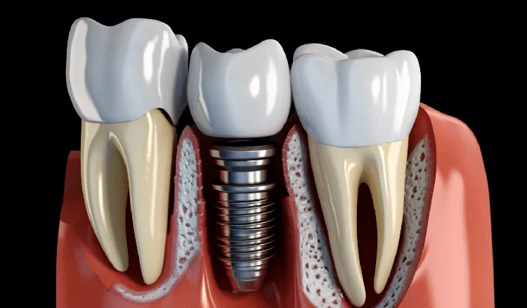 Free Dental Implants for Low Income Individuals and Families