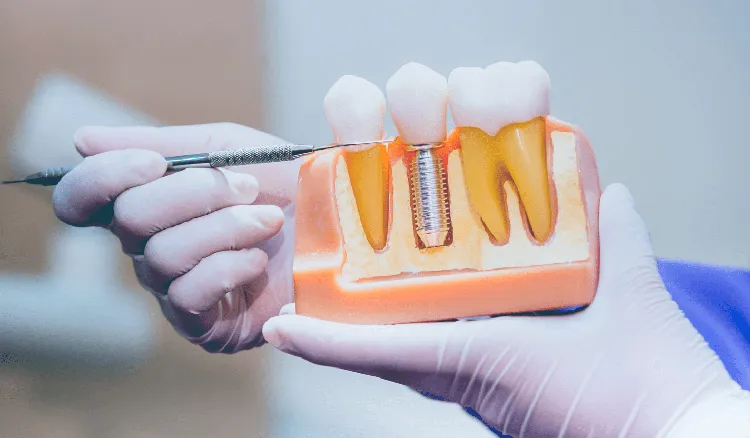 Free dental implants for low-income people