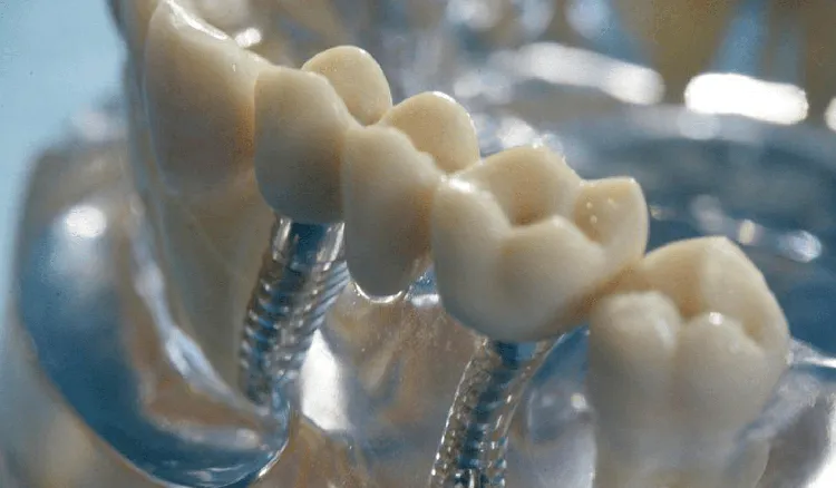How to Get Free Dental Implant in the United States