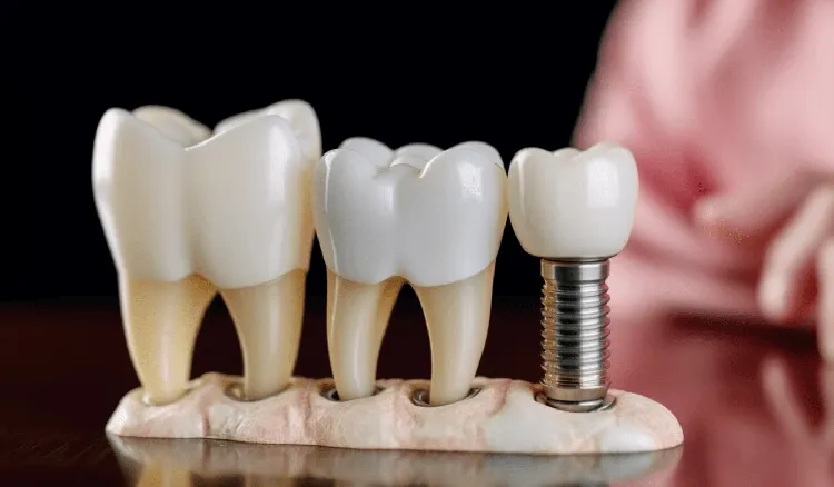 List of Free and Low-Cost Dental Implant Programs in the United States